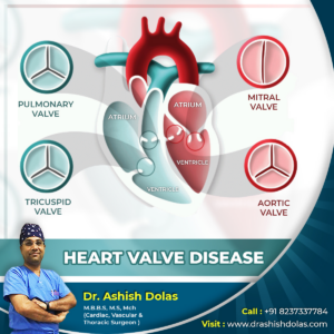 Heart Valve Disease_Article by Dr. Ashish Dolas