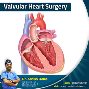 Valvular Heart Surgery