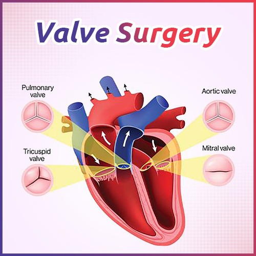 valve surgery