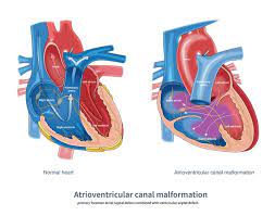 Atrial Septal Defect 