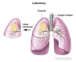 Lobectomy