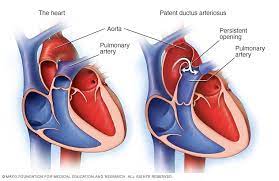 Patent Ductus Arteriosus