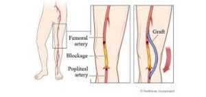 Peripheral Vascular Bypass